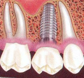 зубной протез
