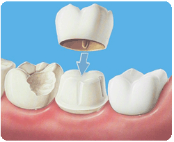 протез из металлокерамики